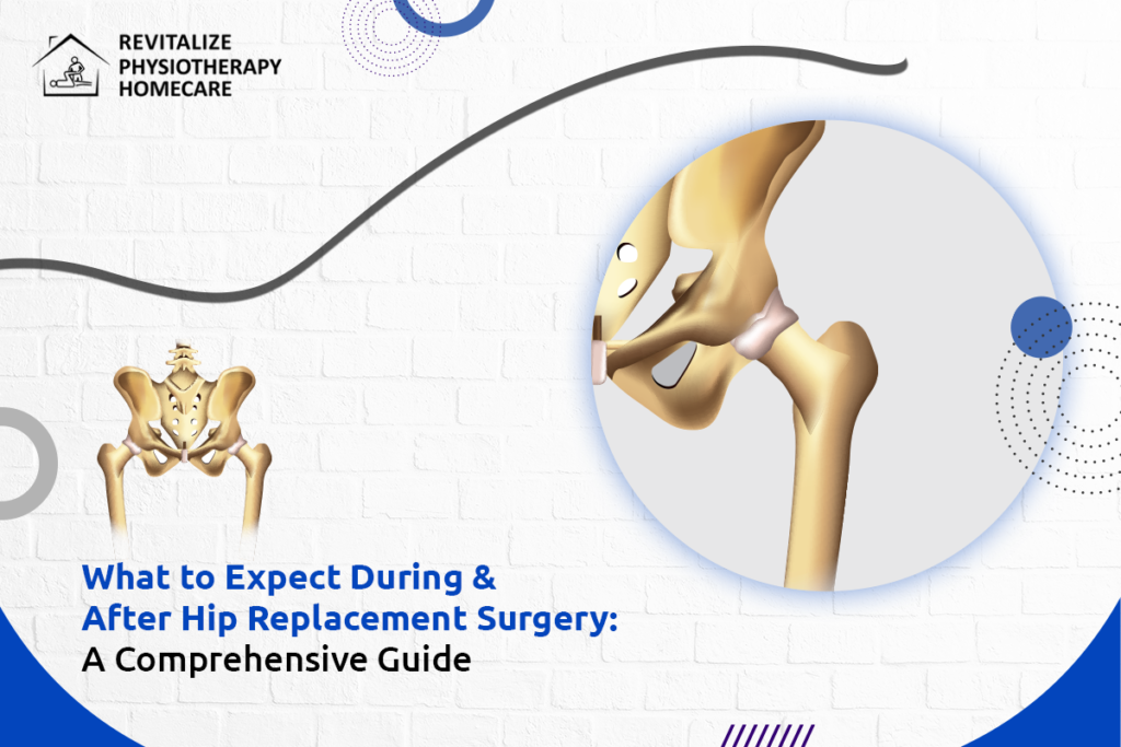 What to Expect During & After Hip Replacement Surgery A Comprehensive