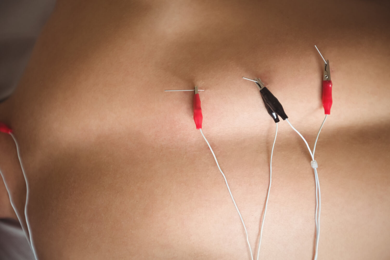 How we Treat with Acupuncture Treatment?