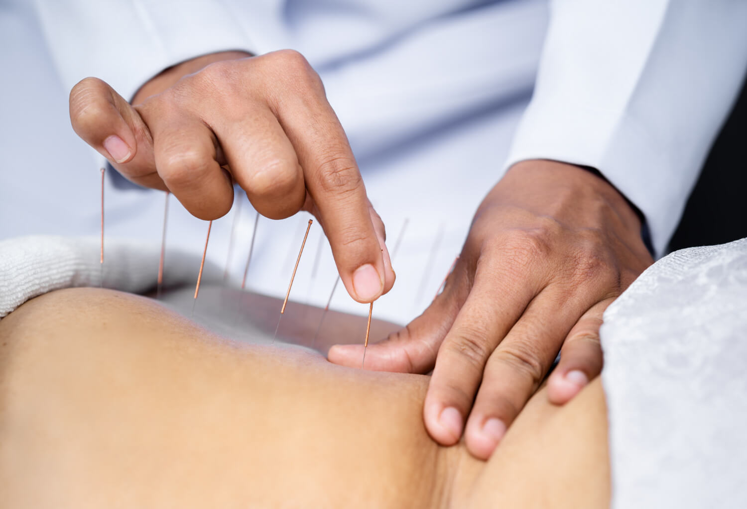 Why Choose Revitalize for Acupuncture Treatment?